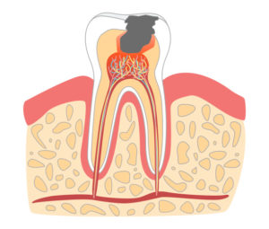 Illustrasjon av skadet tannrot