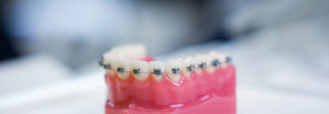 modell av tenner med tannregulering