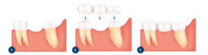 Rehabilitering av tann med tannbro