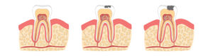 Illustrasjon viser hull i tennene
